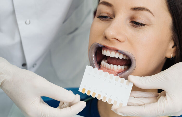 Blanqueamiento Dental: Descubre cómo conseguir una sonrisa radiante y llena de confianza 1 dra-cruz-blog-06