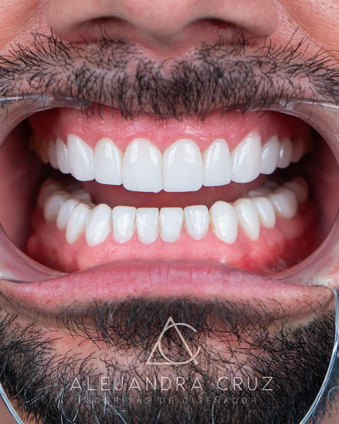 Resultados de DIseño de Sonrisa en porcelana 01