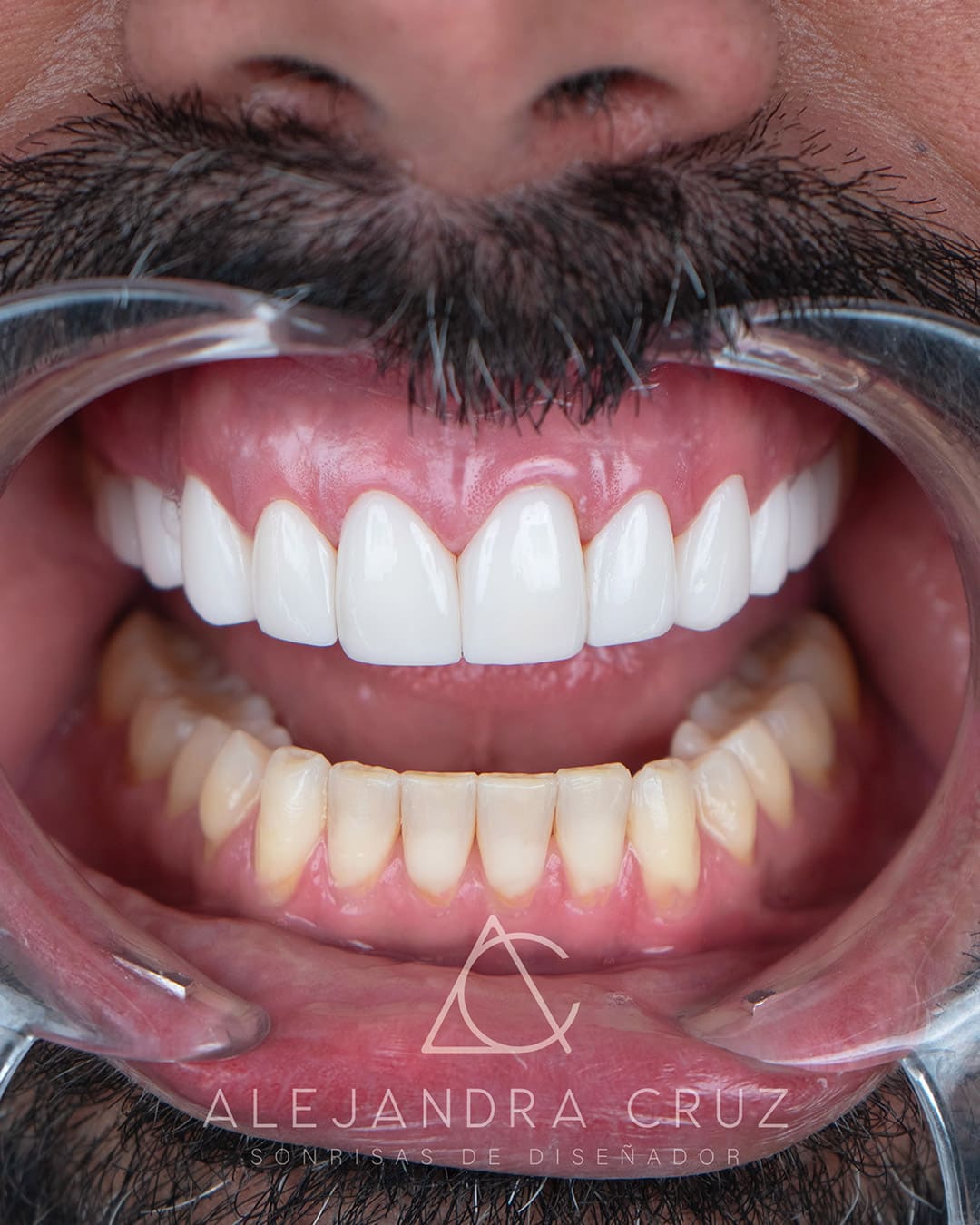 Resultados de DIseño de Sonrisa en porcelana 02