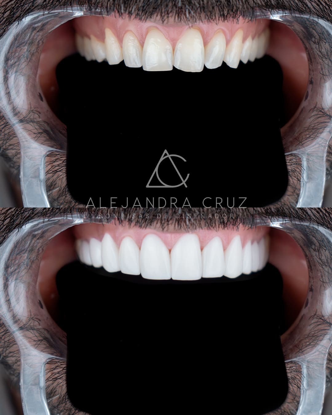 Resultados de DIseño de Sonrisa en porcelana 03