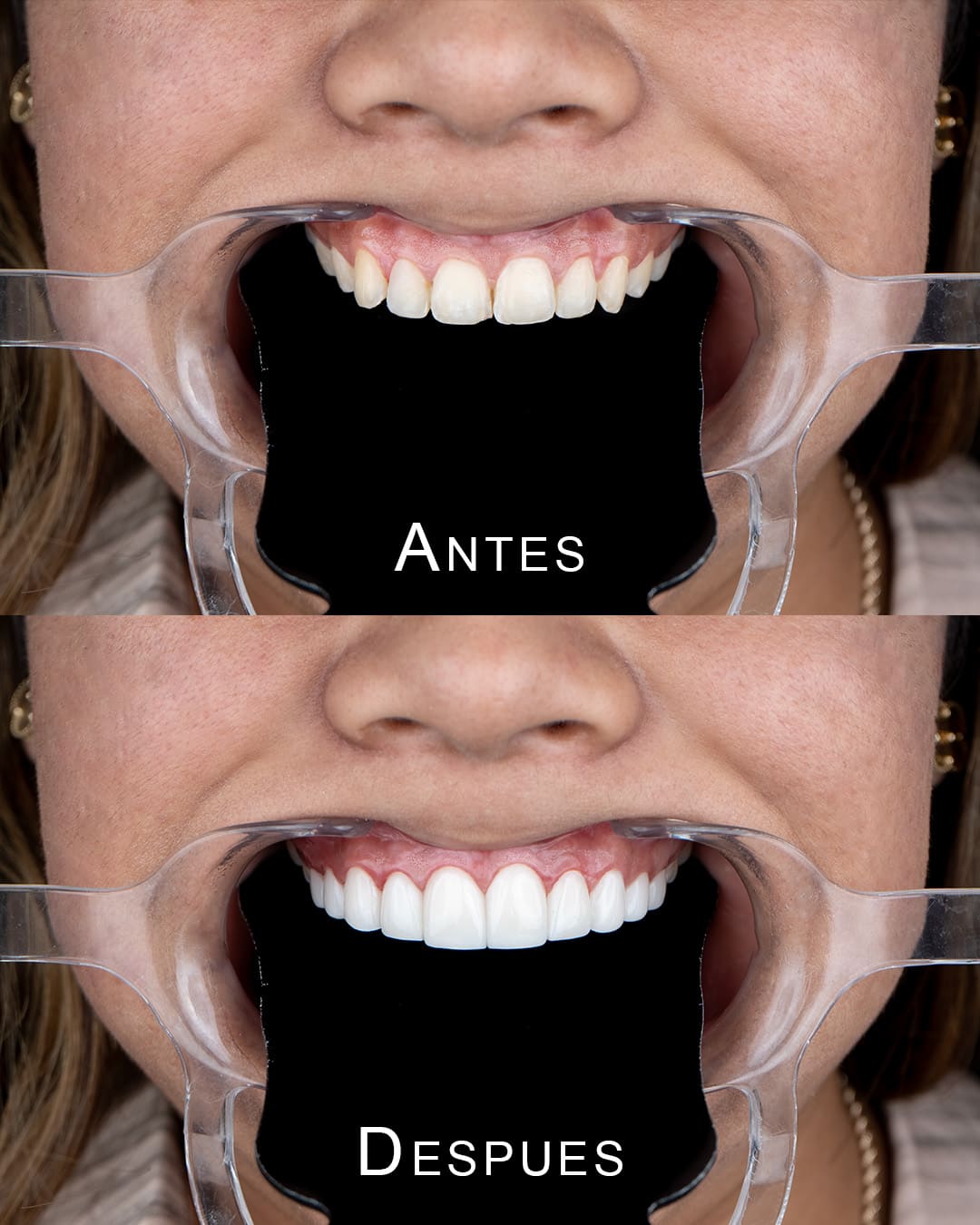 Resultados de DIseño de Sonrisa en porcelana 04