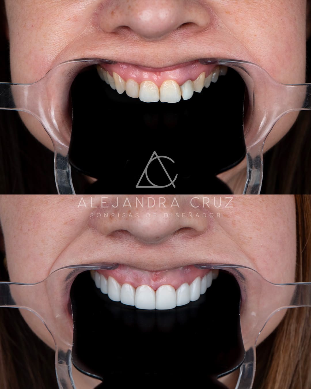 Resultados de DIseño de Sonrisa en porcelana 05