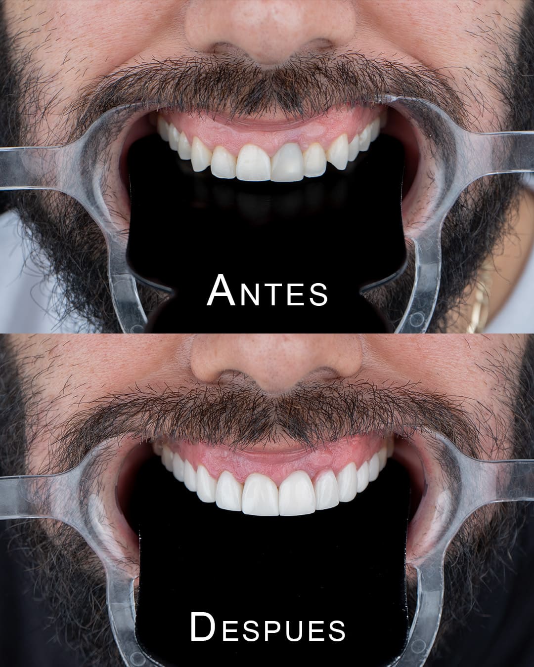 Resultados de DIseño de Sonrisa en porcelana 06