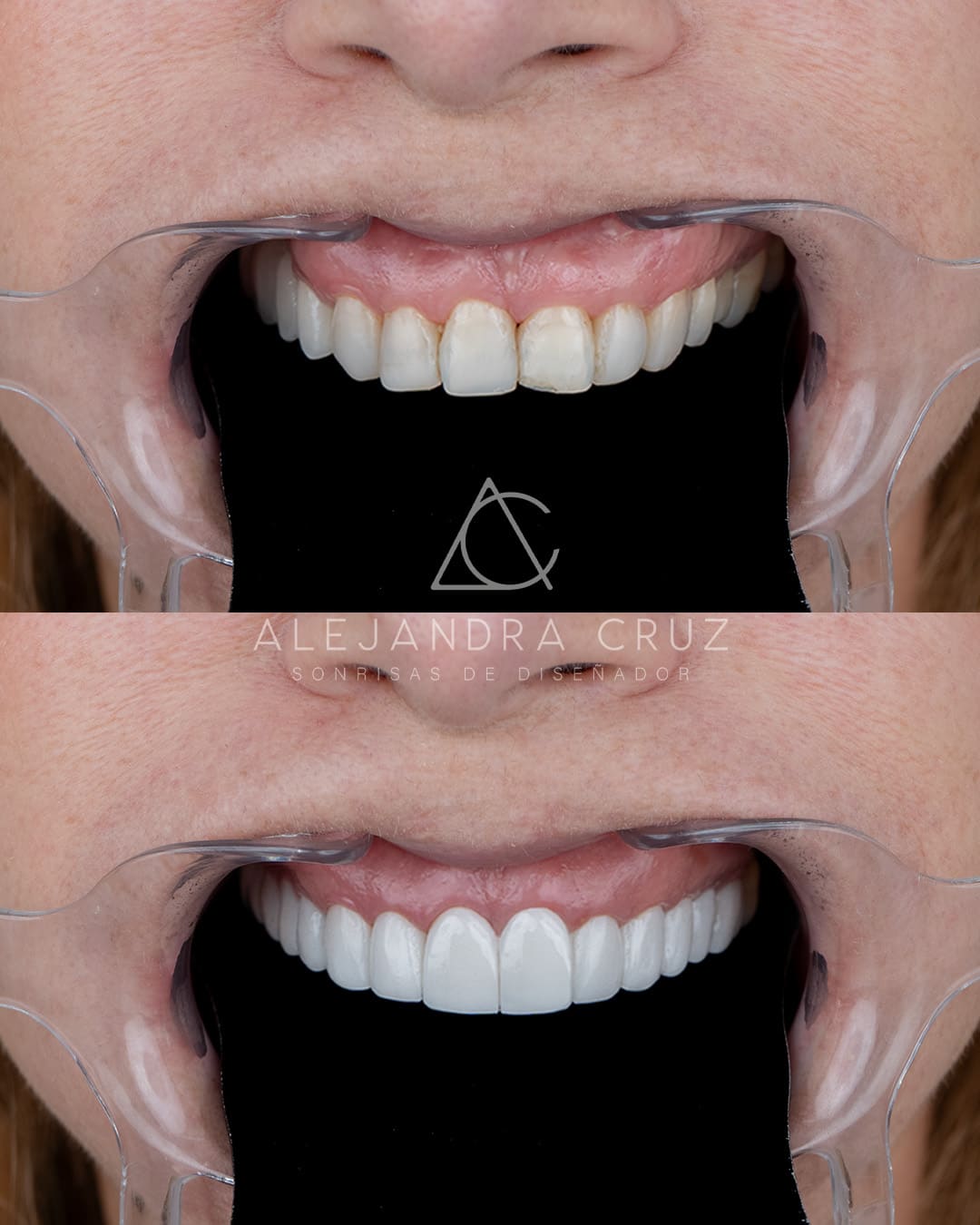 Resultados de DIseño de Sonrisa en porcelana 07