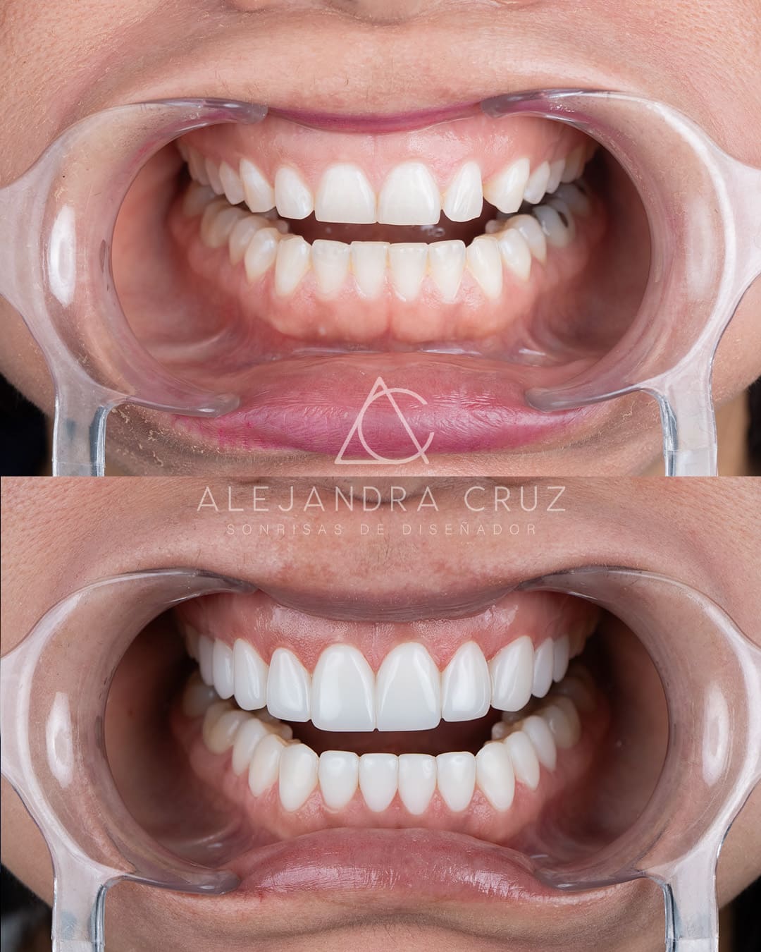 Resultados de DIseño de Sonrisa en resina 01