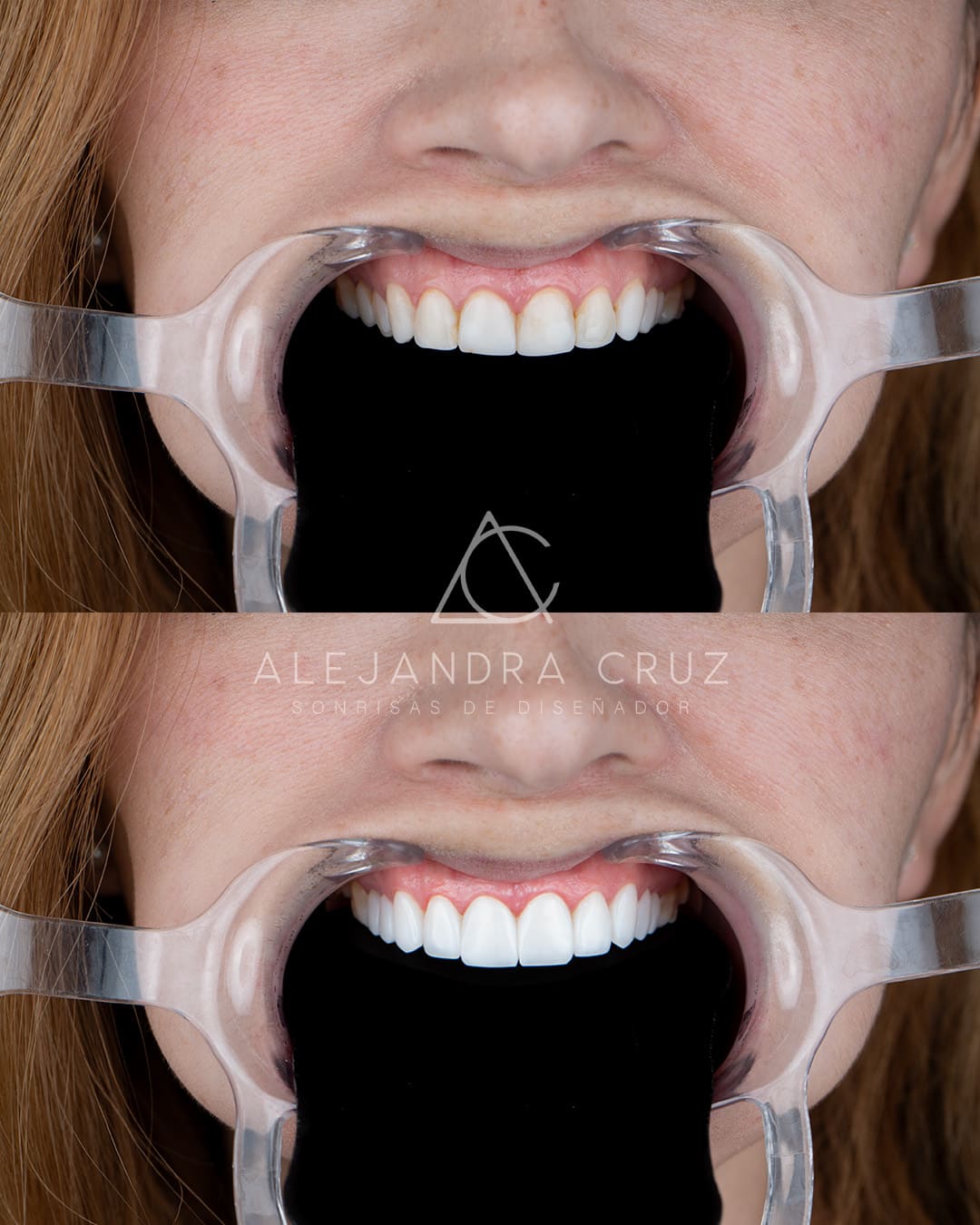 Resultados de DIseño de Sonrisa en resina 02