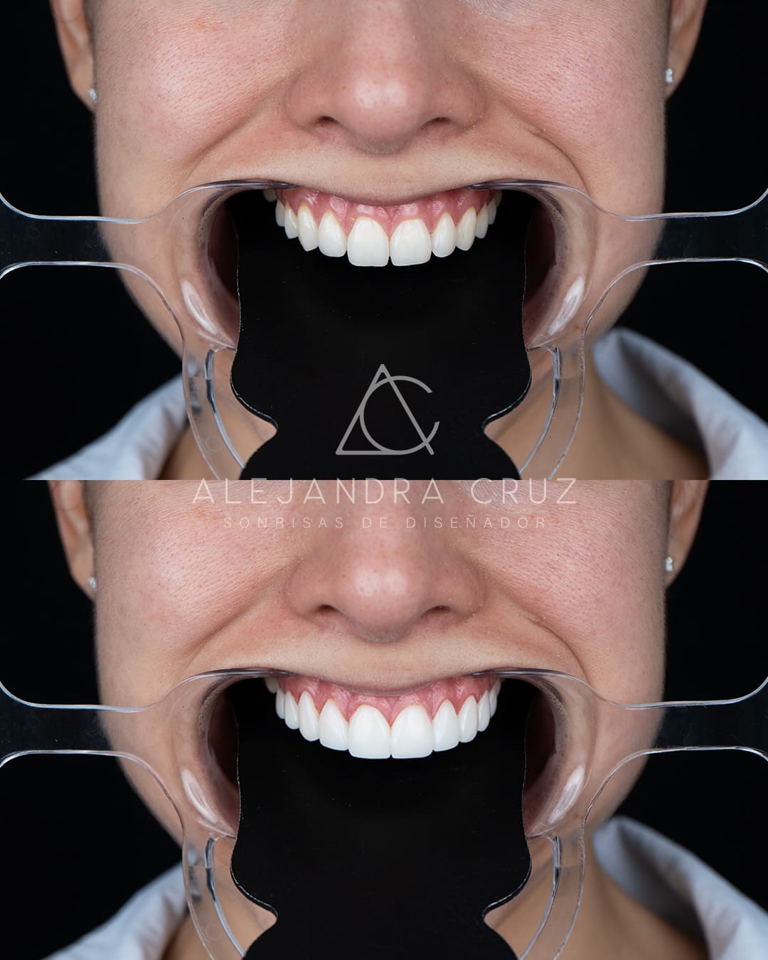 Resultados de DIseño de Sonrisa en resina 03