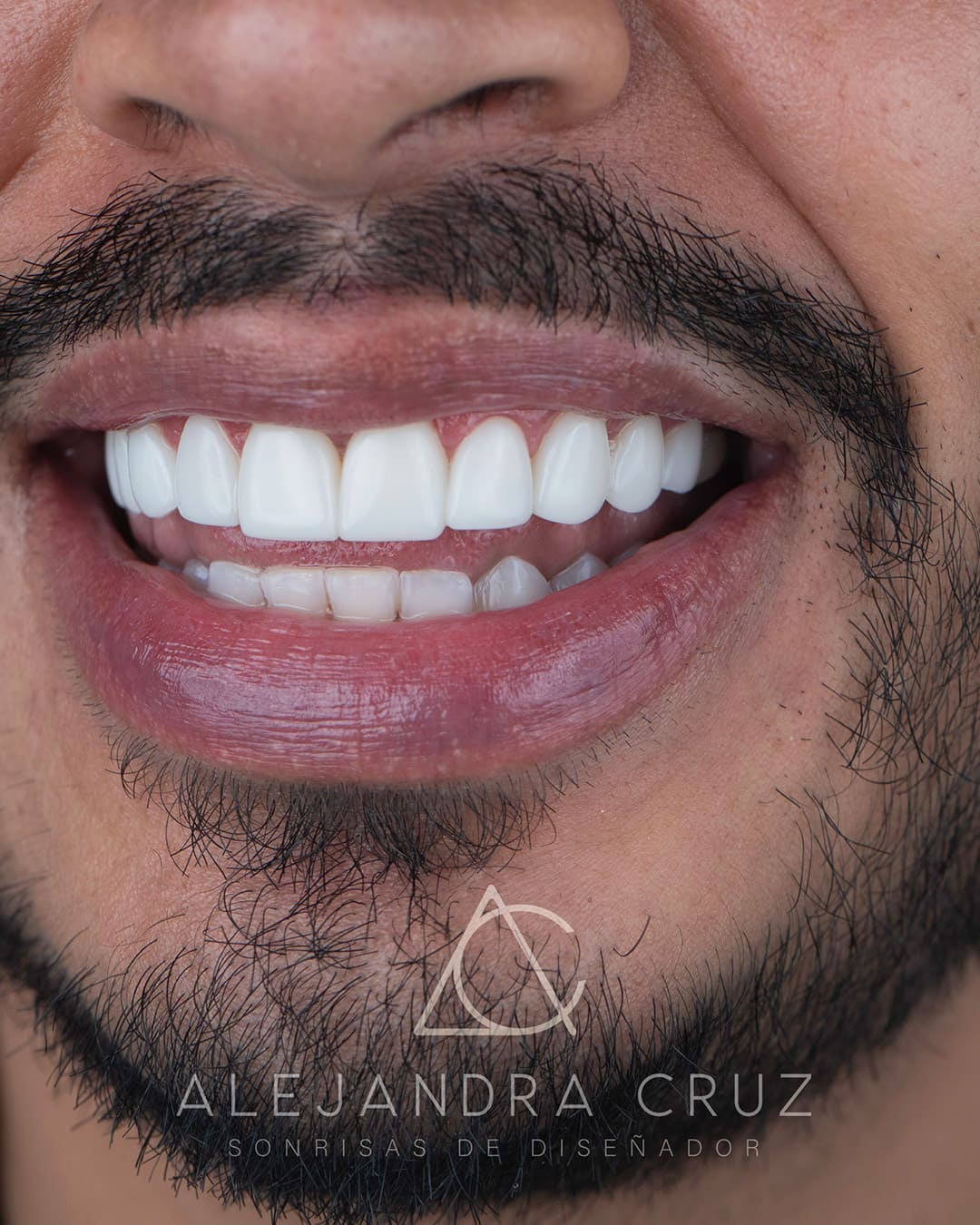 Resultados de DIseño de Sonrisa en resina 04