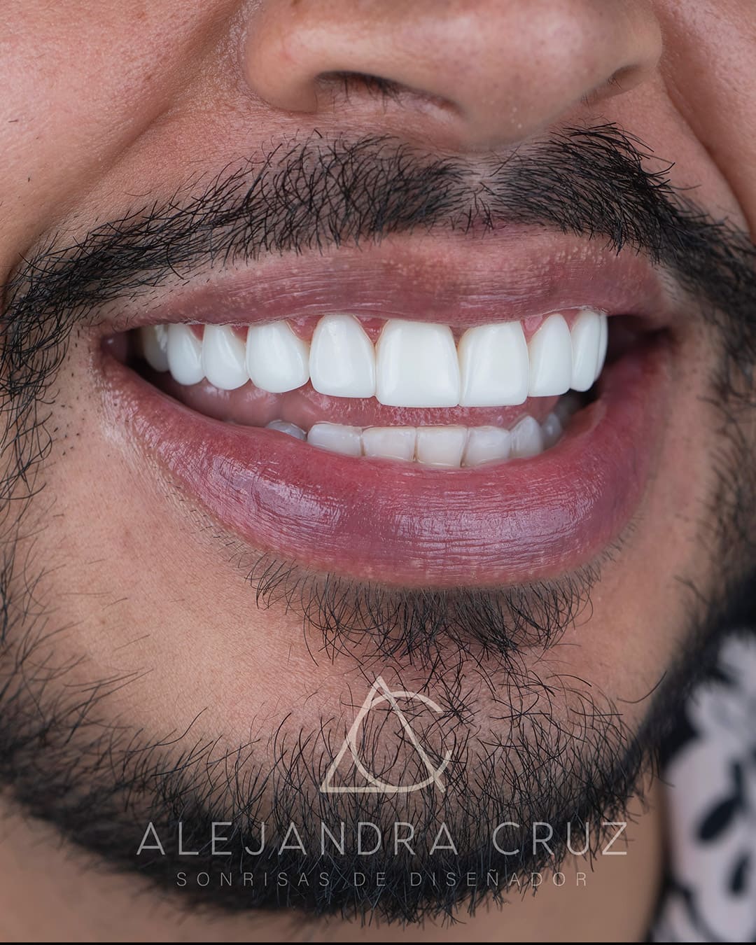 Resultados de DIseño de Sonrisa en resina 05