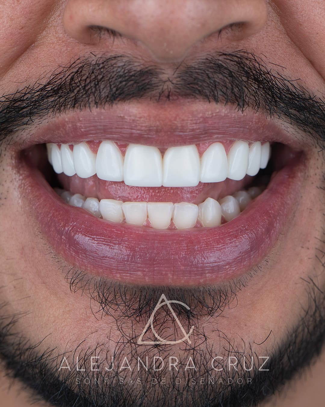 Resultados de DIseño de Sonrisa en resina 06